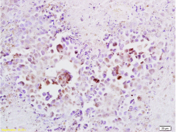 Formalin-fixed and paraffin embedded mouse lymphoma tissue labeled with Anti-Cyclin A2 Polyclonal Antibody (bs-0571R), Unconjugated at 1:100, followed by conjugation to the secondary antibody and DAB staining