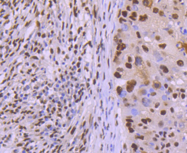 Paraformaldehyde-fixed and paraffin-embedded Human lung cancer tissue incubated with KAP1 (7C5) Monoclonal Antibody (bsm-52679R) at 1:100, overnight at 4°C, followed by a conjugated secondary antibody and DAB staining. Counterstained with hematoxylin.