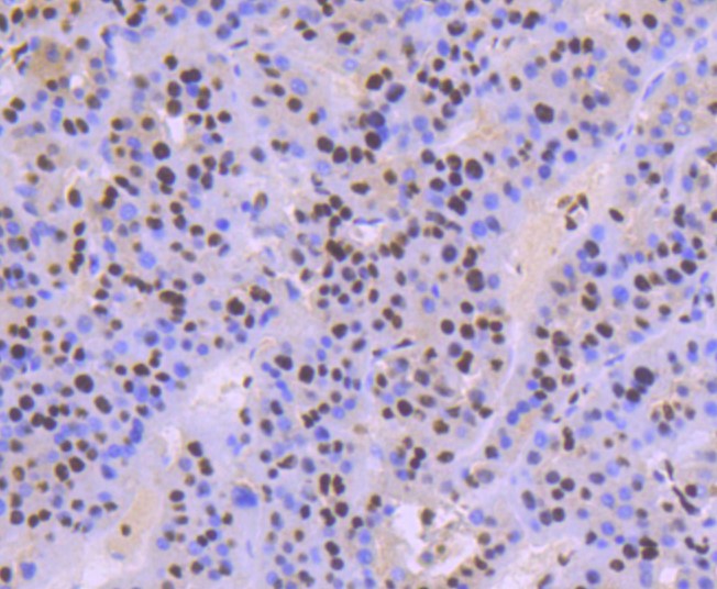 Paraformaldehyde-fixed and paraffin-embedded Human liver cancer tissue incubated with KAP1 (7C5) Monoclonal Antibody (bsm-52679R) at 1:100, overnight at 4°C, followed by a conjugated secondary antibody and DAB staining. Counterstained with hematoxylin.