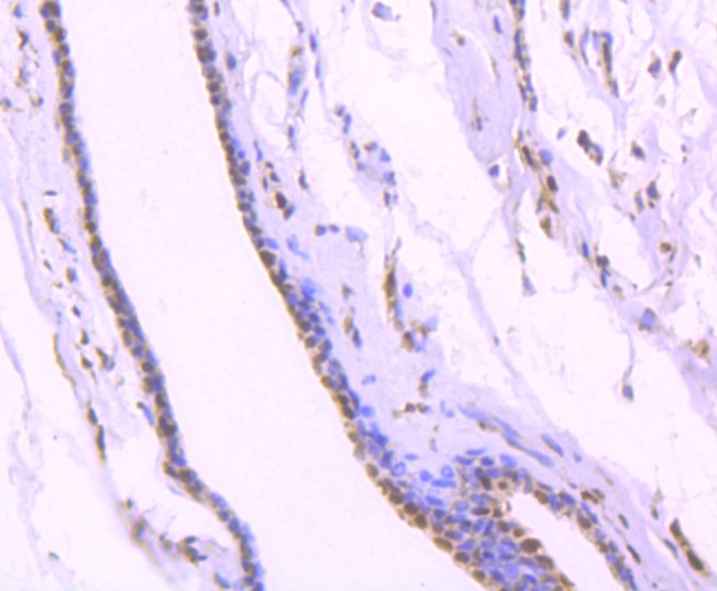 Paraformaldehyde-fixed and paraffin-embedded Human breast carcinoma tissue incubated with KAP1 (7C5) Monoclonal Antibody (bsm-52679R) at 1:100, overnight at 4°C, followed by a conjugated secondary antibody and DAB staining. Counterstained with hematoxylin.