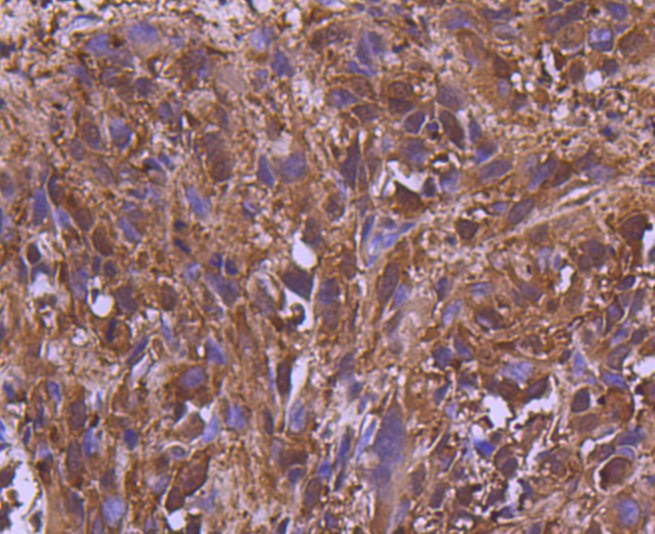 Paraformaldehyde-fixed and paraffin-embedded Human breast carcinoma tissue incubated with MEK2 (2C1) Monoclonal Antibody (bsm-52684R) at 1:300, overnight at 4°C, followed by a conjugated secondary antibody and DAB staining. Counterstained with hematoxylin.