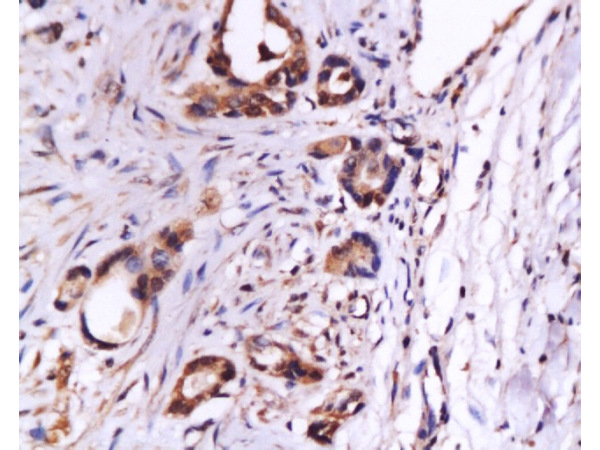 Formalin-fixed and paraffin embedded human gastric carcinoma labeled with Anti-CD105 Polyclonal Antibody (bs-0579R), Unconjugated at 1:200, followed by conjugation to the secondary antibody and DAB staining