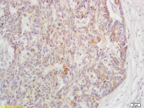 Formalin-fixed and paraffin embedded human rectal carcinoma labeled with Rabbit Anti-Phospho-TAK1(Ser192) Polyclonal Antibody, Unconjugated (bs-5435R) at 1:200 followed by conjugation to the secondary antibody and DAB staining