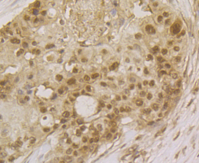 Paraformaldehyde-fixed and paraffin-embedded Human Breast Cancer tissue incubated with SFRS3 (9C11) Monoclonal Antibody (bsm-54467R) at 1:200, overnight at 4°C, followed by a conjugated secondary antibody and DAB staining. Counterstained with hematoxylin. The tissue was pre-treated using heat mediated antigen retrieval with Tris-EDTA buffer (pH 8.0-8.4) for 20 minutes.