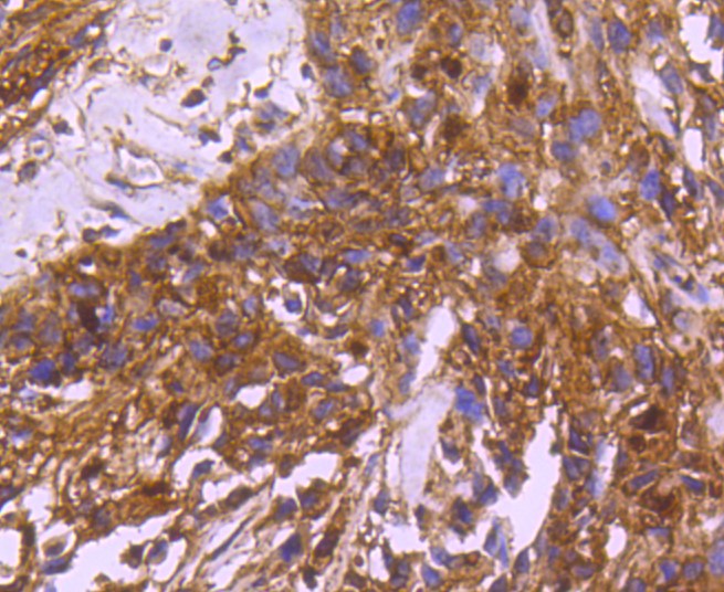 Paraformaldehyde-fixed and paraffin-embedded Human breast carcinoma tissue incubated with 14-3-3 alpha+beta (3C5) Monoclonal Antibody (bsm-52710R) at 1:100, overnight at 4\u00b0C, followed by a conjugated secondary antibody and DAB staining. Counterstained with hematoxylin.