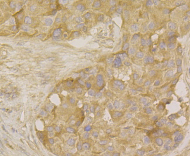 Paraformaldehyde-fixed and paraffin-embedded Human Breast Cancer tissue incubated with MARK3 (2F7) Monoclonal Antibody (bsm-54462R) at 1:100, overnight at 4°C, followed by a conjugated secondary antibody and DAB staining. Counterstained with hematoxylin. The tissue was pre-treated using heat mediated antigen retrieval with Tris-EDTA buffer (pH 8.0-8.4) for 20 minutes.