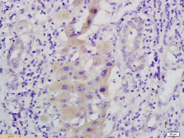 Formalin-fixed and paraffin embedded human hepatoma labeled with Anti-phospho C-Met/HGFR(Tyr1365), Unconjugated(bs-1736R)at 1:200, followed by conjugation to the secondary antibody and DAB staining