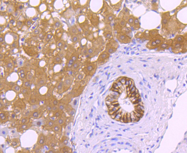 Paraformaldehyde-fixed and paraffin-embedded Human liver cancer tissue incubated with Carbonic anhydrase 9 (7C4) Monoclonal Antibody (bsm-52738R) at 1:100, overnight at 4°C, followed by a conjugated secondary antibody and DAB staining. Counterstained with hematoxylin.