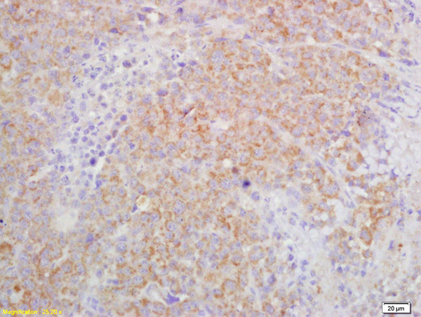 Formalin-fixed and paraffin embedded mouse lymphoma labeled with Rabbit Anti IL-27R/TCCR Polyclonal Antibody, Unconjugated (bs-2711R) at 1:200 followed by conjugation to the secondary antibody and DAB staining