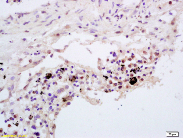 Formalin-fixed and paraffin embedded  human lung carcinoma  labeled with  Rabbit Anti TNFAIP3/A20 Polyclonal Antibody, Unconjugated (bs-2803R) at 1:200 followed by conjugation to the secondary antibody and DAB staining