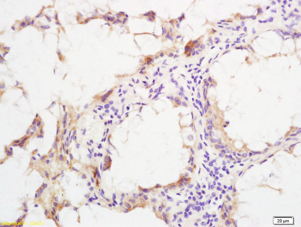 Formalin-fixed and paraffin embedded human rectal carcinoma labeled with Rabbit Anti phospho-SHC(Ser36) Polyclonal Antibody, Unconjugated (bs-3410R) at 1:200 followed by conjugation to the secondary antibody and DAB staining