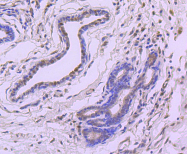Paraformaldehyde-fixed and paraffin-embedded Human breast carcinoma tissue incubated with eIF4EBP1 (9C1) Monoclonal Antibody (bsm-52771R) at 1:100, overnight at 4°C, followed by a conjugated secondary antibody and DAB staining. Counterstained with hematoxylin.