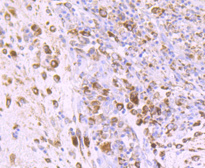 Paraformaldehyde-fixed and paraffin-embedded Human colon cancer tissue incubated with IGF2 (1T3) Monoclonal Antibody (bsm-52776R) at 1:100, overnight at 4°C, followed by a conjugated secondary antibody and DAB staining. Counterstained with hematoxylin.