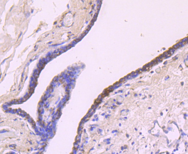 Paraformaldehyde-fixed and paraffin-embedded Human breast carcinoma tissue incubated with IGF2 (1T3) Monoclonal Antibody (bsm-52776R) at 1:100, overnight at 4°C, followed by a conjugated secondary antibody and DAB staining. Counterstained with hematoxylin.