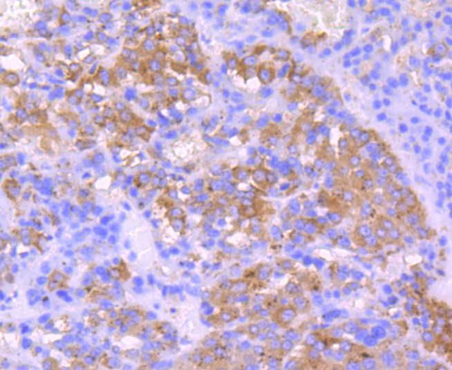 Paraformaldehyde-fixed and paraffin-embedded Human liver cancer tissue incubated with IGF2 (1T3) Monoclonal Antibody (bsm-52776R) at 1:100, overnight at 4°C, followed by a conjugated secondary antibody and DAB staining. Counterstained with hematoxylin.