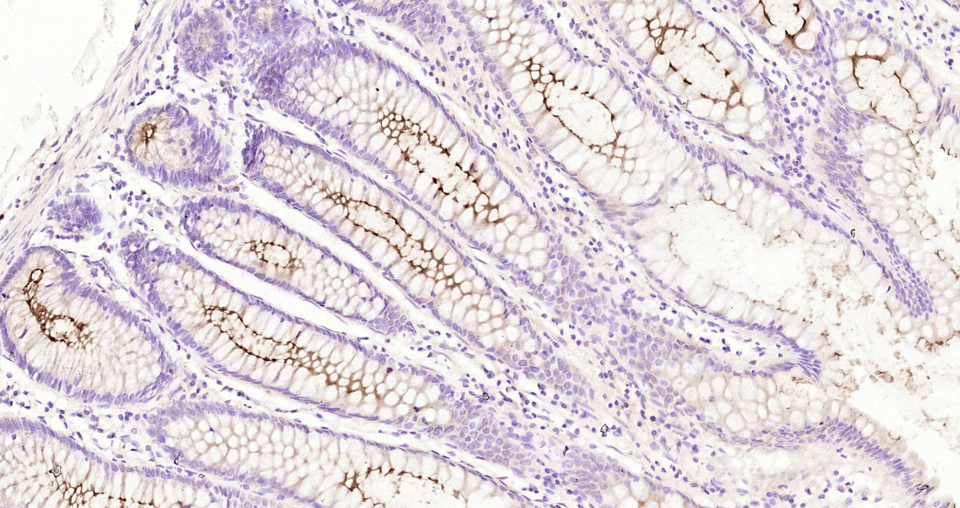 Paraformaldehyde-fixed, paraffin embedded Human colon cancer; Antigen retrieval by boiling in sodium citrate buffer (pH6.0) for 15min; Block endogenous peroxidase by 3% hydrogen peroxide for 20 minutes; Blocking buffer (normal goat serum) at 37°C for 30min; Antibody incubation with MUC1 Polyclonal Antibody, Unconjugated (bs-1497R) at 1:200 overnight at 4°C, DAB staining.