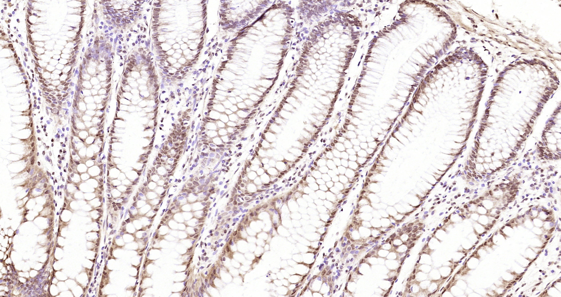 Paraformaldehyde-fixed, paraffin embedded Human colon cancer; Antigen retrieval by boiling in sodium citrate buffer (pH6.0) for 15min; Block endogenous peroxidase by 3% hydrogen peroxide for 20 minutes; Blocking buffer (normal goat serum) at 37°C for 30min; Antibody incubation with CDKN1A (Thr145) Polyclonal Antibody, Unconjugated (bs-5237R) at 1:200 overnight at 4°C, DAB staining.