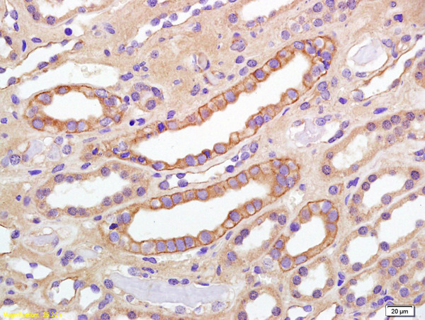 Formalin-fixed and paraffin embedded human kidney carcinoma labeled with Anti phospho-IGF1R(Tyr980) Polyclonal Antibody,Unconjugated (bs-5447R) at 1:200 followed by conjugation to the secondary antibody and DAB staining