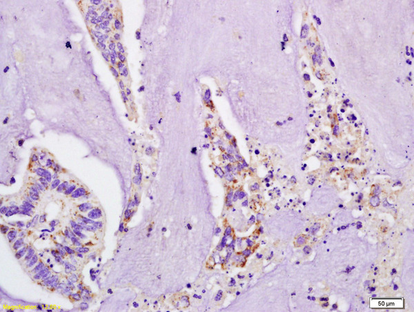 Formalin-fixed and paraffin embedded human colon carcinoma  labeled with  Rabbit Anti IL-4R\/CD124 Plastin Polyclonal Antibody, Unconjugated (bs-2458R) at 1:200 followed by conjugation to the secondary antibody and DAB staining