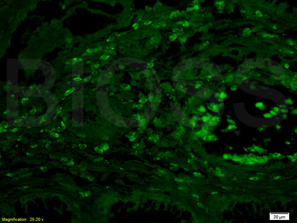 Formalin-fixed and paraffin embedded human colon carcinoma labeled Anti-IL-4R/CD124 Polyclonal Antibody, Unconjugated (bs-2458R) at 1:200 followed by conjugation to the secondary antibody Goat Anti-Rabbit IgG, AF488 conjugated(bs-0295G-AF488)used at 1:200 dilution Formalin-fixed and paraffin embedded human colon carcinoma labeled Anti-IL-4R/CD124 Polyclonal Antibody, Unconjugated (bs-2458R) at 1:200 followed by conjugation to the secondary antibody Goat Anti-Rabbit IgG, AF488 conjugated(bs-0295G-AF488)used at 1:200 dilution