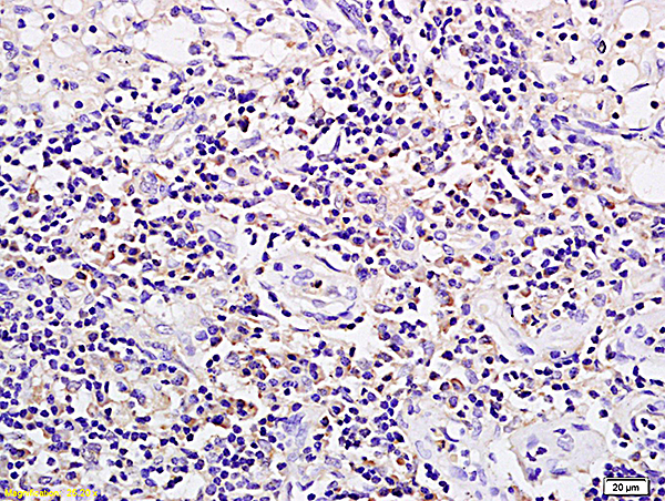 Formalin-fixed and paraffin embedded rat xenograft tumor tissue labeled with Anti SPP24/SPP2 Polyclonal Antibody, Unconjugated (bs-8518R) followed by conjugation to the secondary antibody and DAB staining\n