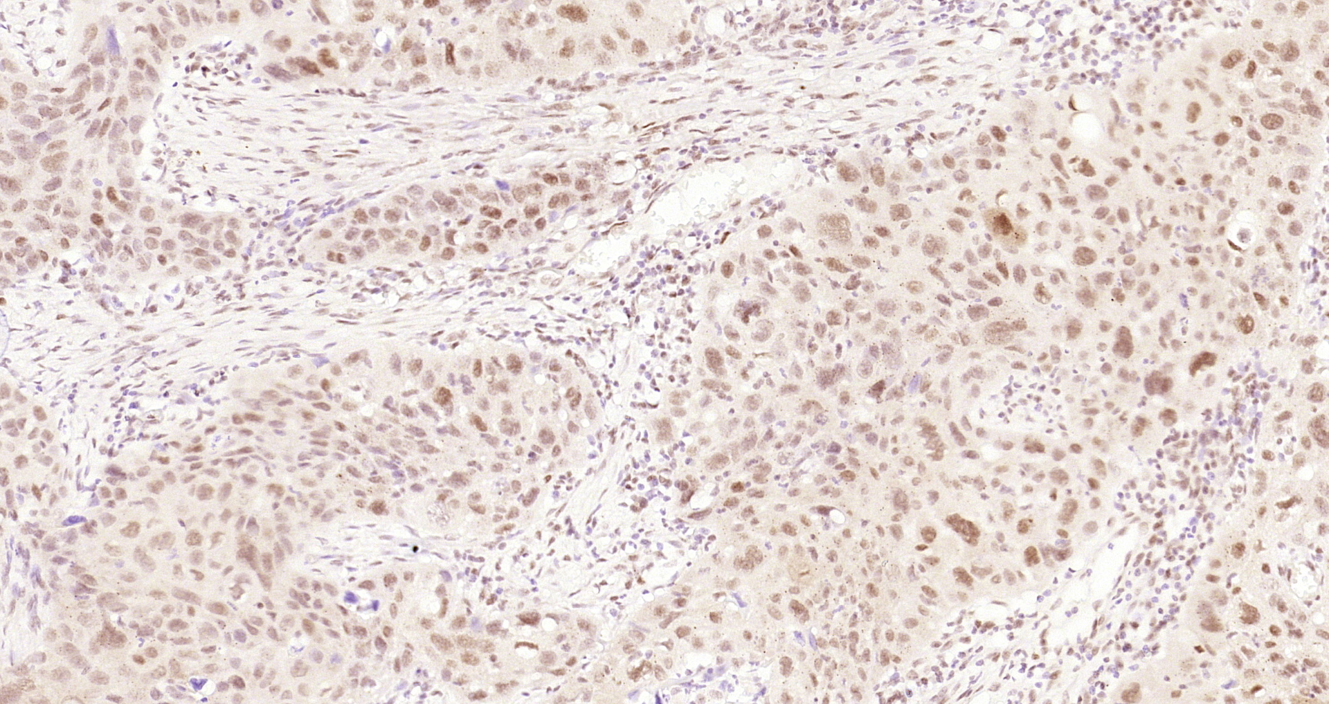 Paraformaldehyde-fixed and paraffin-embedded Human laryngeal cancer tissue incubated with Cyclin E1 (4H7) Monoclonal Antibody (bsm-52048R) at 1:200, overnight at 4\u00b0C, followed by a conjugated secondary antibody and DAB staining. Counterstained with hematoxylin.
