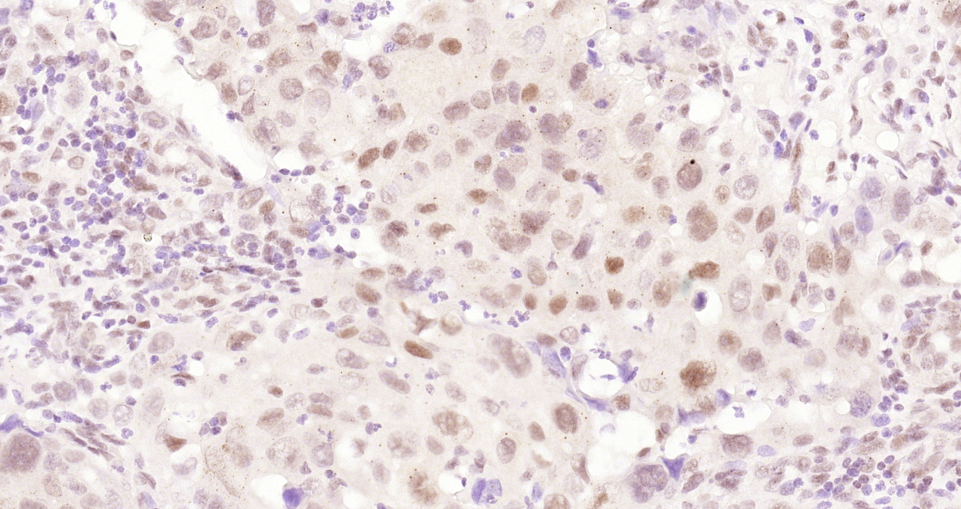 Paraformaldehyde-fixed and paraffin-embedded Human laryngeal cancer tissue incubated with Cyclin E1 (4H7) Monoclonal Antibody (bsm-52048R) at 1:200, overnight at 4\u00b0C, followed by a conjugated secondary antibody and DAB staining. Counterstained with hematoxylin.
