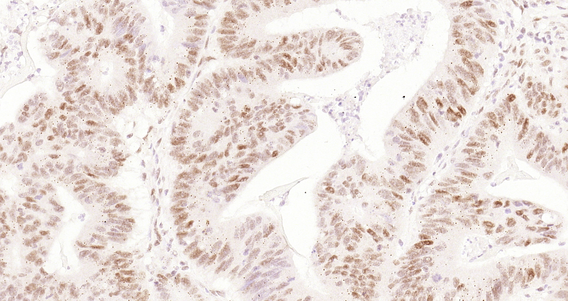 Paraformaldehyde-fixed and paraffin-embedded Human colon cancer tissue incubated with Cyclin E1 (4H7) Monoclonal Antibody (bsm-52048R) at 1:200, overnight at 4\u00b0C, followed by a conjugated secondary antibody and DAB staining. Counterstained with hematoxylin.