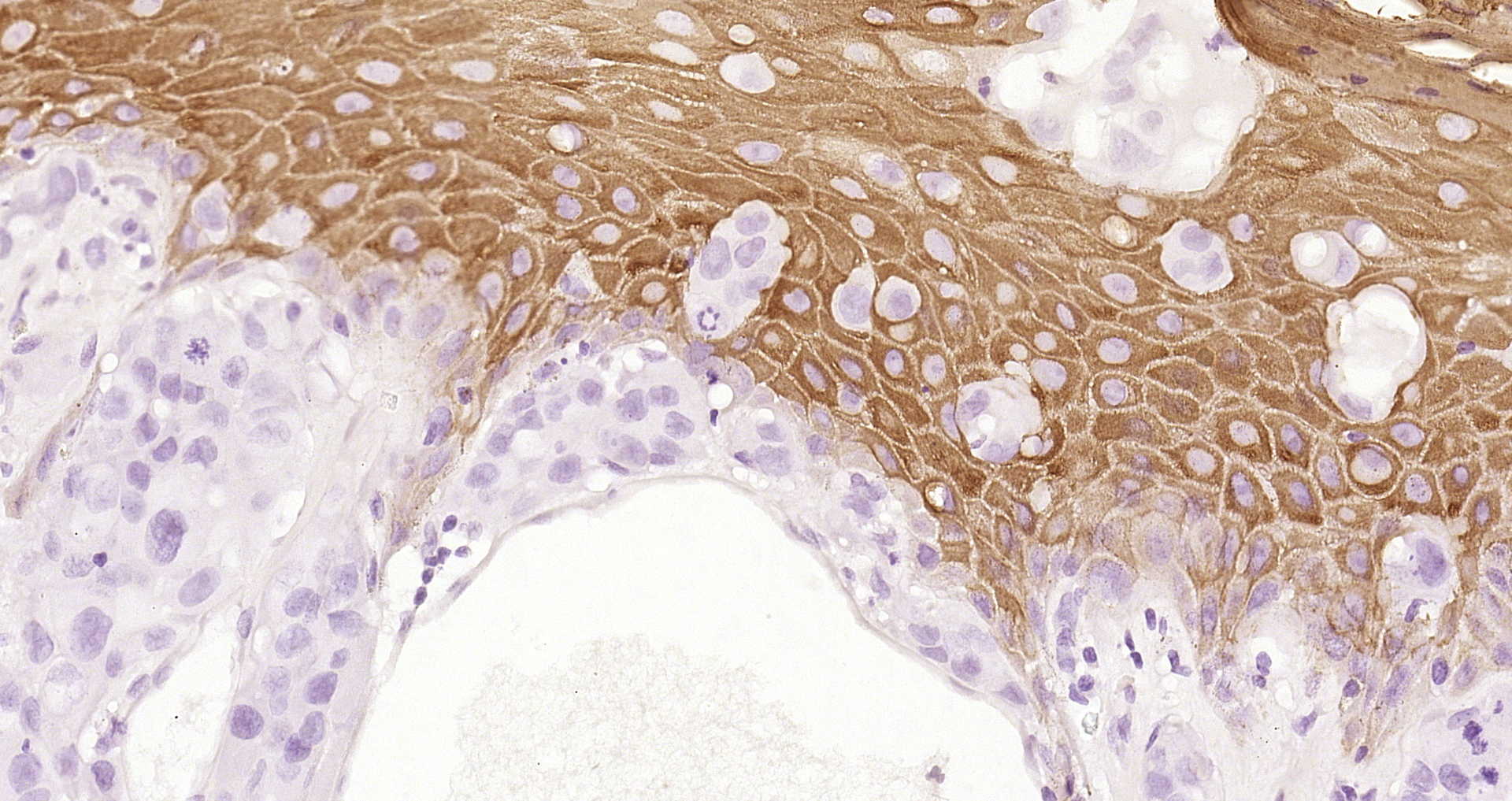 Paraformaldehyde-fixed and paraffin-embedded Human skin cancer tissue incubated with Cytokeratin 2e (2F7) Monoclonal Antibody (bsm-52061R) at 1:200, overnight at 4\u00b0C, followed by a conjugated secondary antibody and DAB staining. Counterstained with hematoxylin.