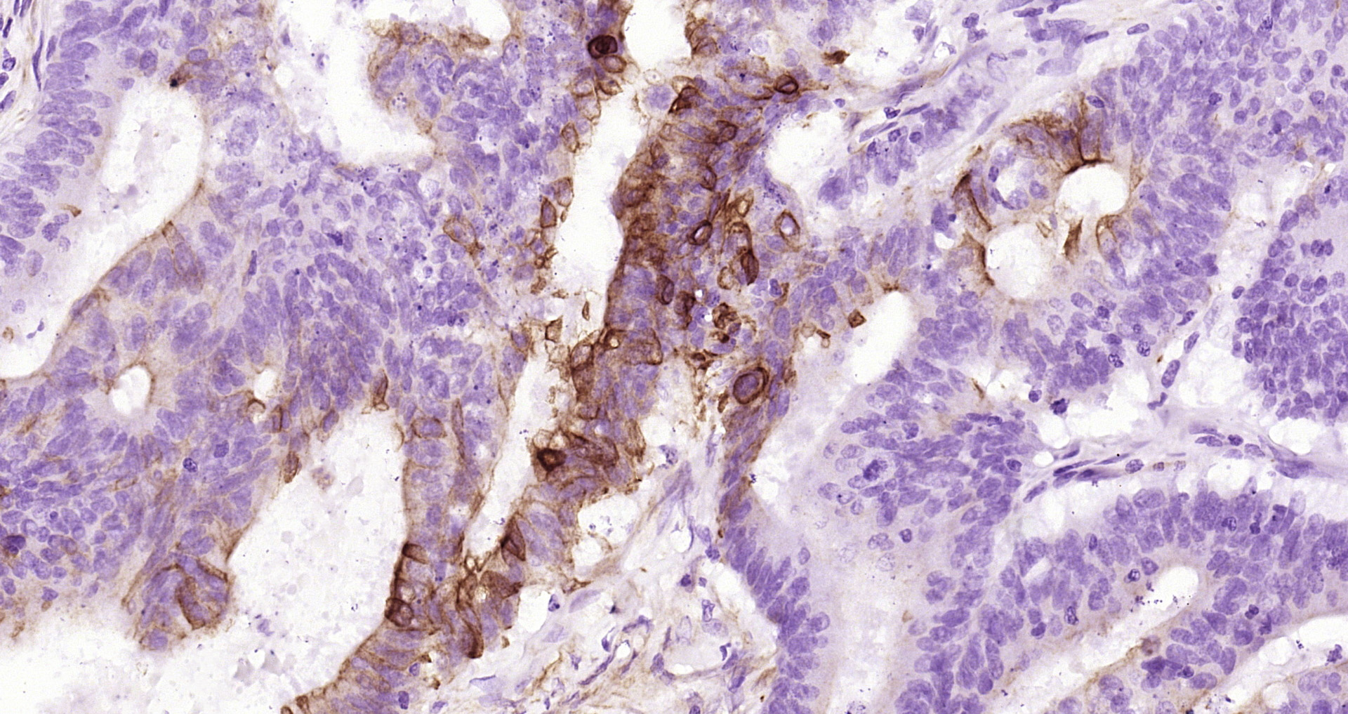 Paraformaldehyde-fixed and paraffin-embedded Human colon cancer tissue incubated with GSK3 beta(Ser 9) (7A4) Monoclonal Antibody (bsm-52160R) at 1:200, overnight at 4\u00b0C, followed by a conjugated secondary antibody and DAB staining. Counterstained with hematoxylin.