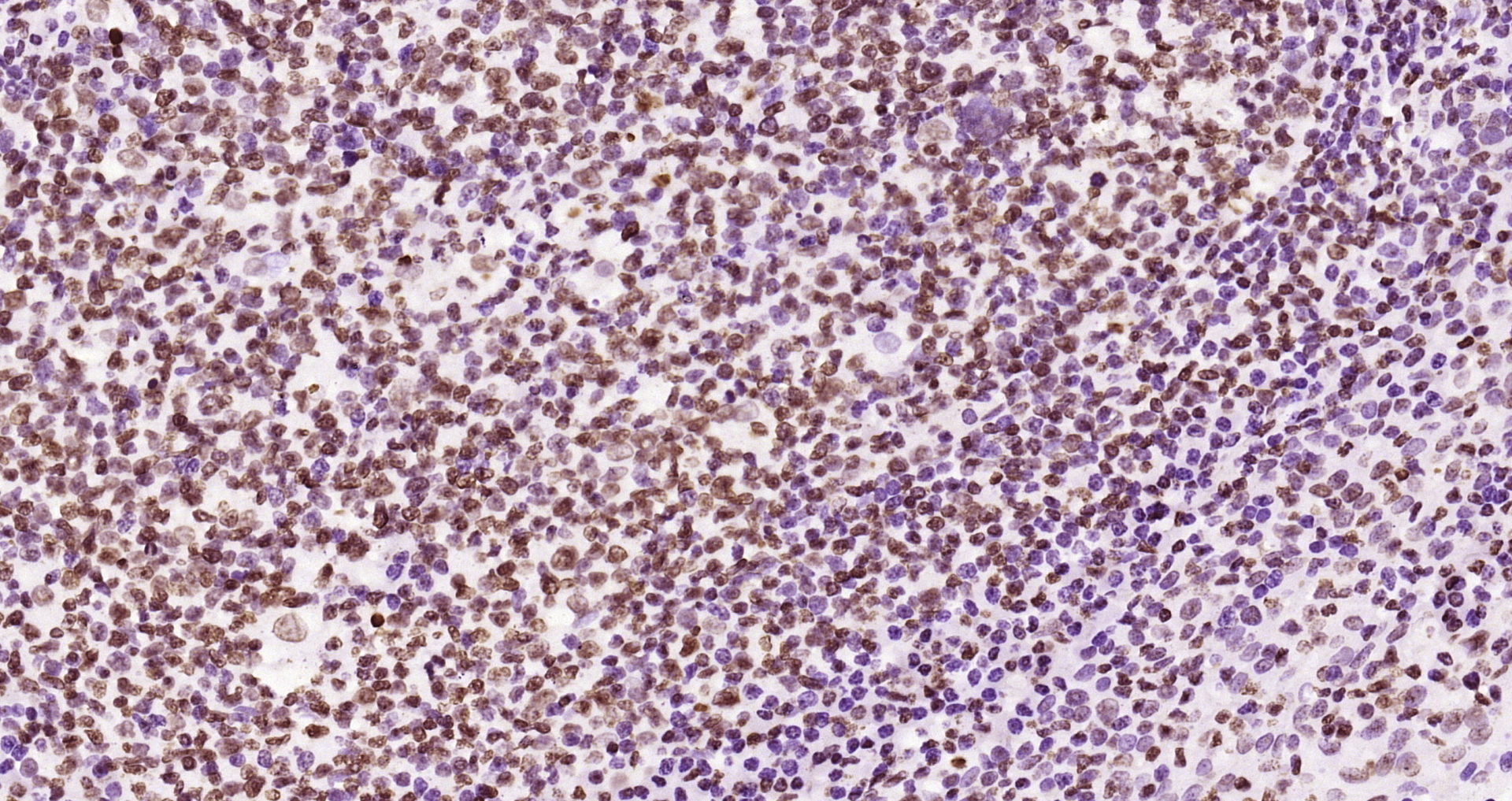 Paraformaldehyde-fixed and paraffin-embedded Human tonsil tissue incubated with JAK2(Y1007+Y1008) (6E5) Monoclonal Antibody (bsm-52171R) at 1:200, overnight at 4\u00b0C, followed by a conjugated secondary antibody and DAB staining. Counterstained with hematoxylin.