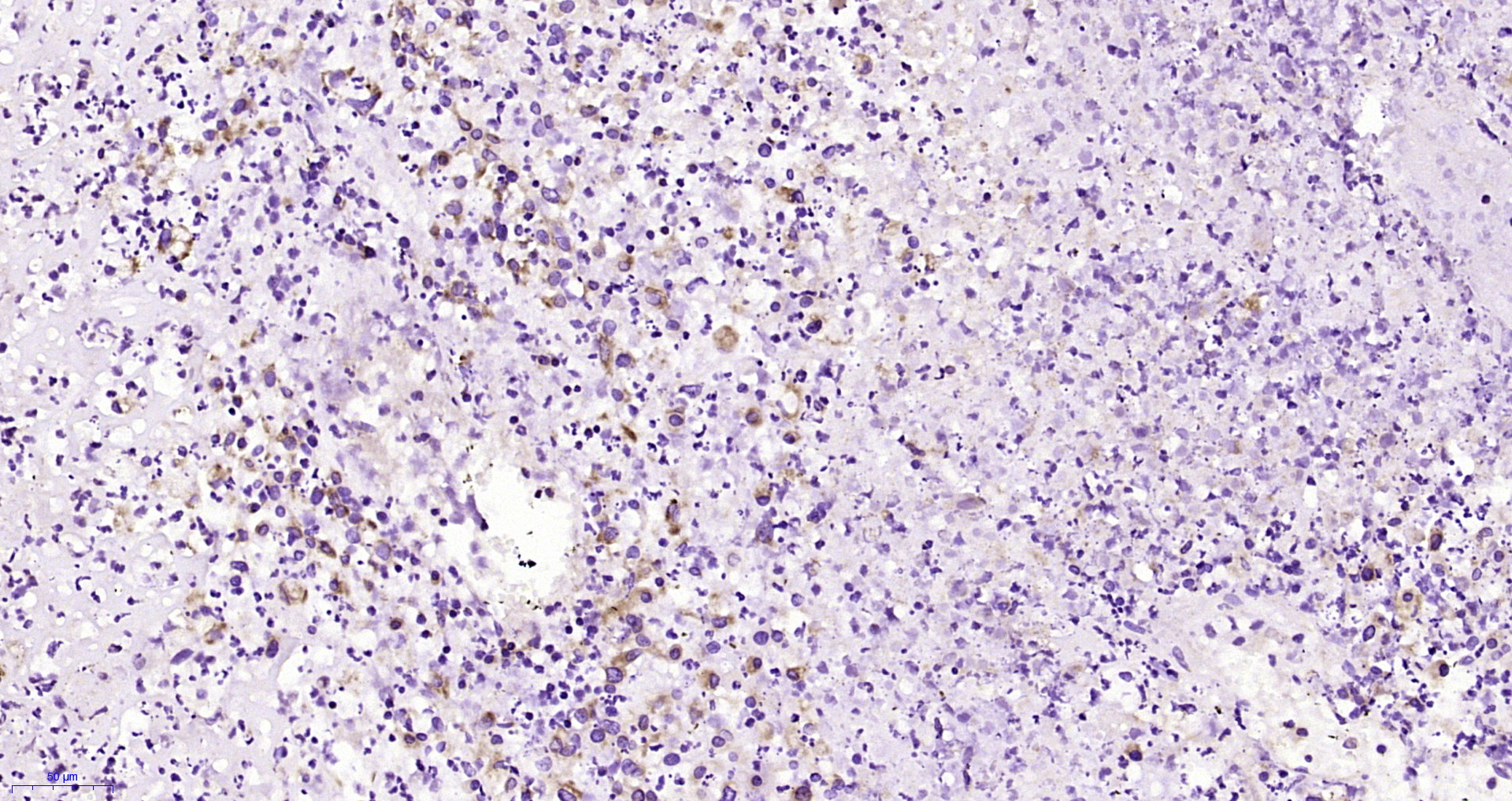 Paraformaldehyde-fixed, paraffin embedded Human endometrial cancer; Antigen retrieval by boiling in sodium citrate buffer (pH6.0) for 15min; Block endogenous peroxidase by 3% hydrogen peroxide for 20 minutes; Blocking buffer (normal goat serum) at 37°C for 30min; Antibody incubation with IFN-beta Polyclonal Antibody, Unconjugated (bs-0787R) at 1:200 overnight at 4°C, DAB staining.