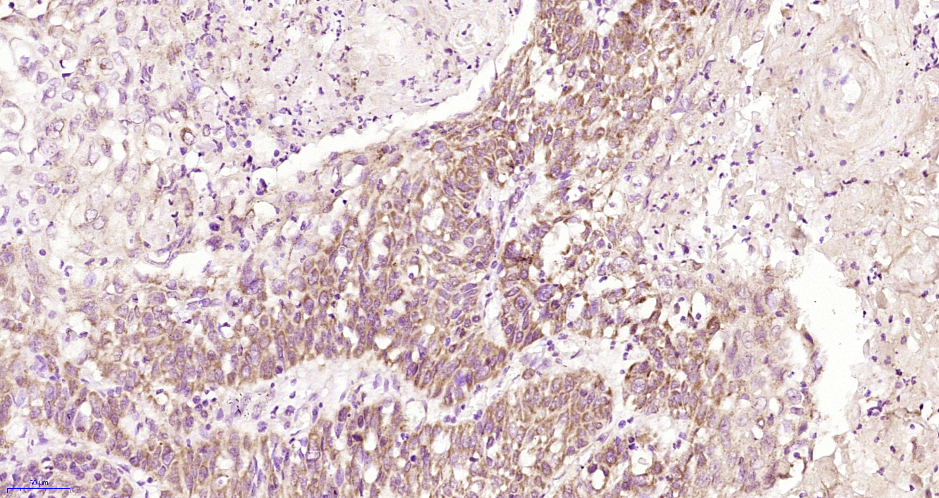 Paraformaldehyde-fixed, paraffin embedded Human esophageal cancer; Antigen retrieval by boiling in sodium citrate buffer (pH6.0) for 15min; Block endogenous peroxidase by 3% hydrogen peroxide for 20 minutes; Blocking buffer (normal goat serum) at 37°C for 30min; Antibody incubation with TEM8 Polyclonal Antibody, Unconjugated (bs-15583R) at 1:200 overnight at 4°C, DAB staining. Paraformaldehyde-fixed, paraffin embedded Human esophageal cancer; Antigen retrieval by boiling in sodium citrate buffer (pH6.0) for 15min; Block endogenous peroxidase by 3% hydrogen peroxide for 20 minutes; Blocking buffer (normal goat serum) at 37°C for 30min; Antibody incubation with TEM8 Polyclonal Antibody, Unconjugated (bs-15583R) at 1:200 overnight at 4°C, DAB staining.