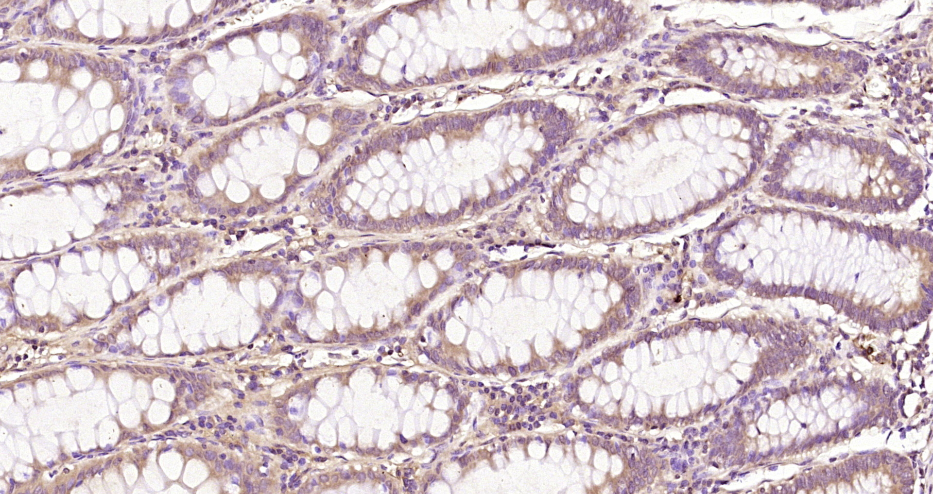 Paraformaldehyde-fixed, paraffin embedded Human colon cancer; Antigen retrieval by boiling in sodium citrate buffer (pH6.0) for 15min; Block endogenous peroxidase by 3% hydrogen peroxide for 20 minutes; Blocking buffer (normal goat serum) at 37°C for 30min; Antibody incubation with MAPKAPK5 Polyclonal Antibody, Unconjugated (bs-4137R) at 1:200 overnight at 4°C, DAB staining.