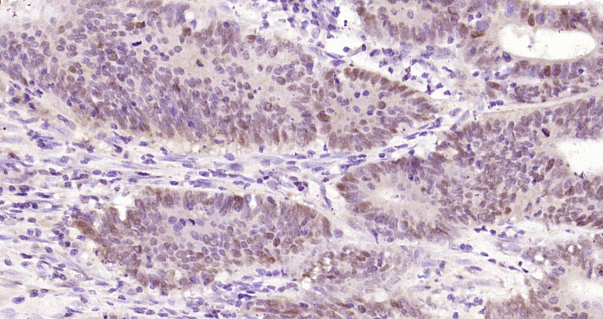 Paraformaldehyde-fixed, paraffin embedded Human colon cancer; Antigen retrieval by boiling in sodium citrate buffer (pH6.0) for 15min; Block endogenous peroxidase by 3% hydrogen peroxide for 20 minutes; Blocking buffer (normal goat serum) at 37°C for 30min; Antibody incubation with UGDH Polyclonal Antibody, Unconjugated (bs-6715R) at 1:200 overnight at 4°C, DAB staining.