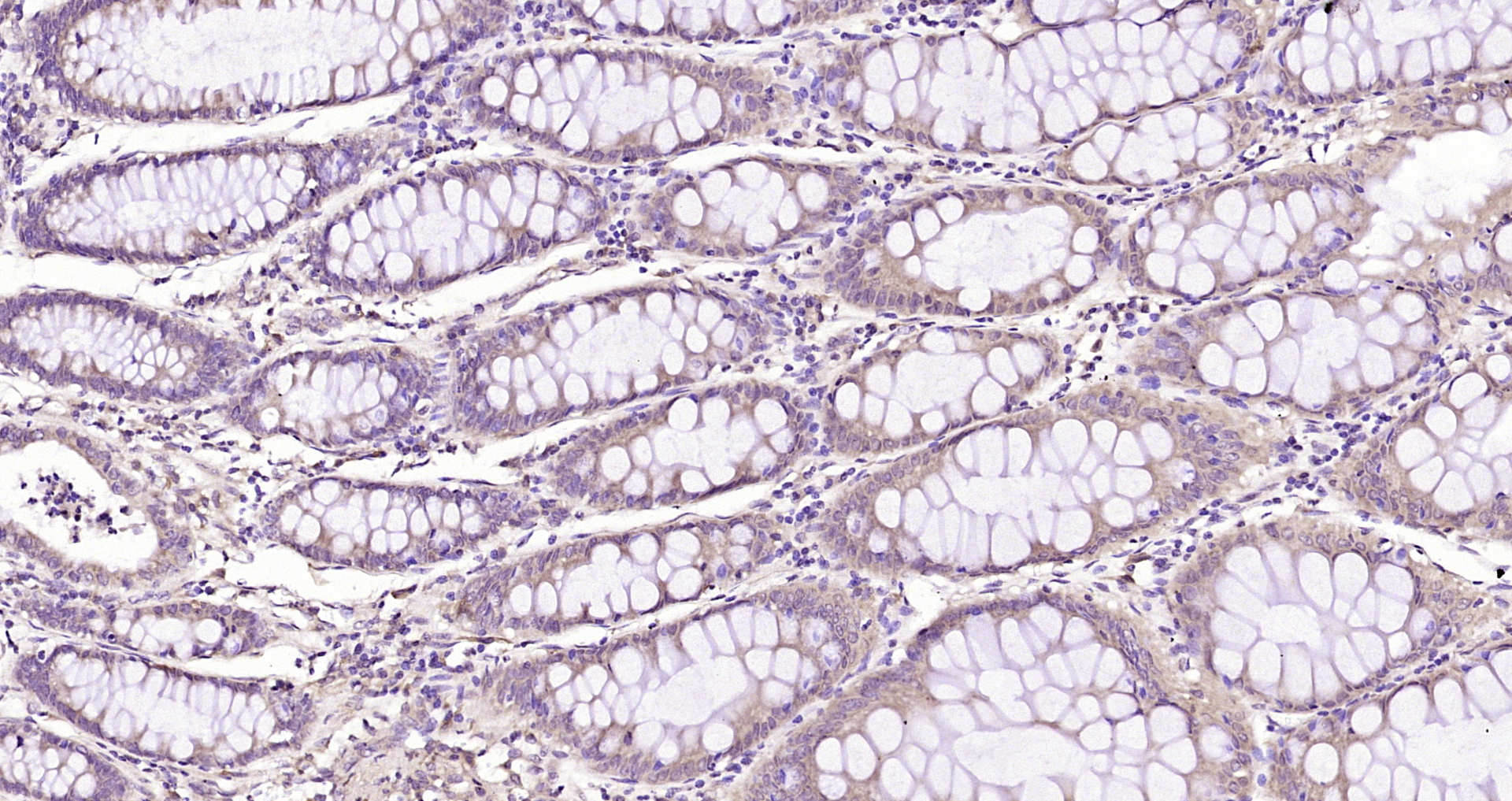 Paraformaldehyde-fixed, paraffin embedded Human colon cancer; Antigen retrieval by boiling in sodium citrate buffer (pH6.0) for 15min; Block endogenous peroxidase by 3% hydrogen peroxide for 20 minutes; Blocking buffer (normal goat serum) at 37°C for 30min; Antibody incubation with HINT1 Polyclonal Antibody, Unconjugated (bs-10228R) at 1:200 overnight at 4°C, DAB staining.