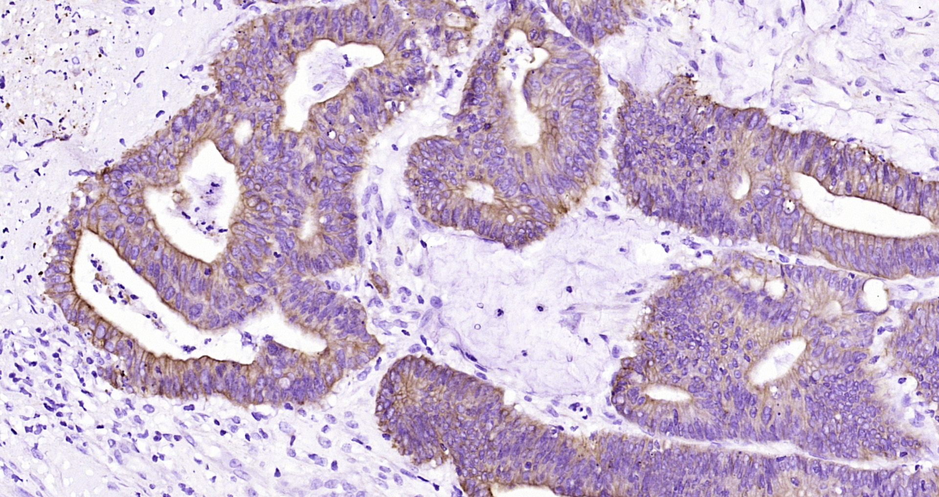Paraformaldehyde-fixed, paraffin embedded Human colon cancer; Antigen retrieval by boiling in sodium citrate buffer (pH6.0) for 15min; Block endogenous peroxidase by 3% hydrogen peroxide for 20 minutes; Blocking buffer (normal goat serum) at 37°C for 30min; Antibody incubation with CK18 Monoclonal Antibody, Unconjugated (bsm-33103M) at 1:400 overnight at 4°C, DAB staining.