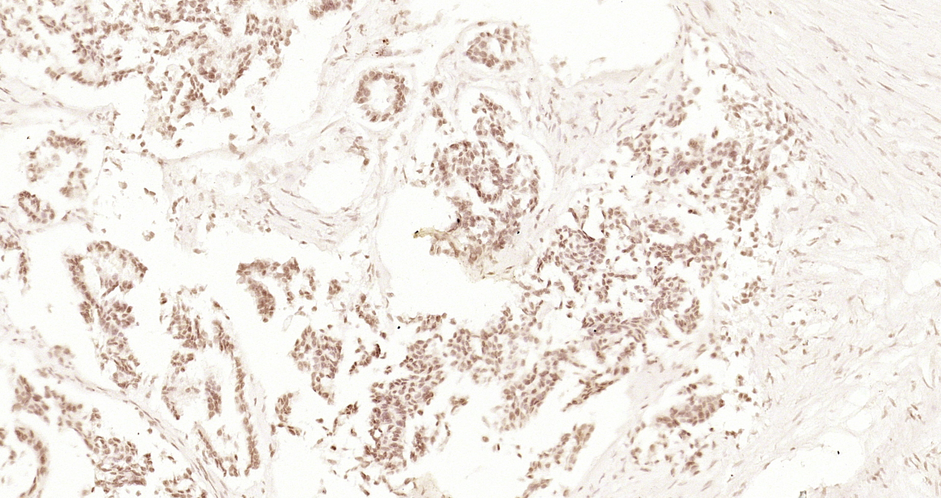 Paraformaldehyde-fixed, paraffin embedded Human stomach cancer; Antigen retrieval by boiling in sodium citrate buffer (pH6.0) for 15min; Block endogenous peroxidase by 3% hydrogen peroxide for 20 minutes; Blocking buffer (normal goat serum) at 37°C for 30min; Antibody incubation with XPB Polyclonal Antibody, Unconjugated (bs-4260R) at 1:200 overnight at 4°C, DAB staining.