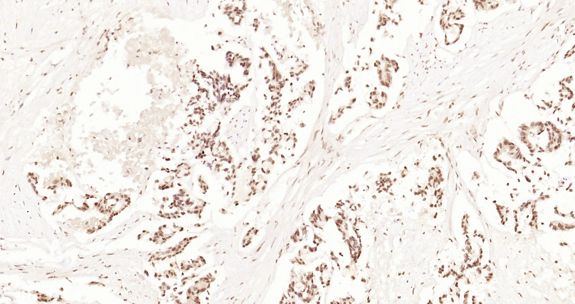 Paraformaldehyde-fixed, paraffin embedded Human stomach cancer; Antigen retrieval by boiling in sodium citrate buffer (pH6.0) for 15min; Block endogenous peroxidase by 3% hydrogen peroxide for 20 minutes; Blocking buffer (normal goat serum) at 37°C for 30min; Antibody incubation with JNK1 + 3 Polyclonal Antibody, Unconjugated (bs-0501R) at 1:200 overnight at 4°C, DAB staining.