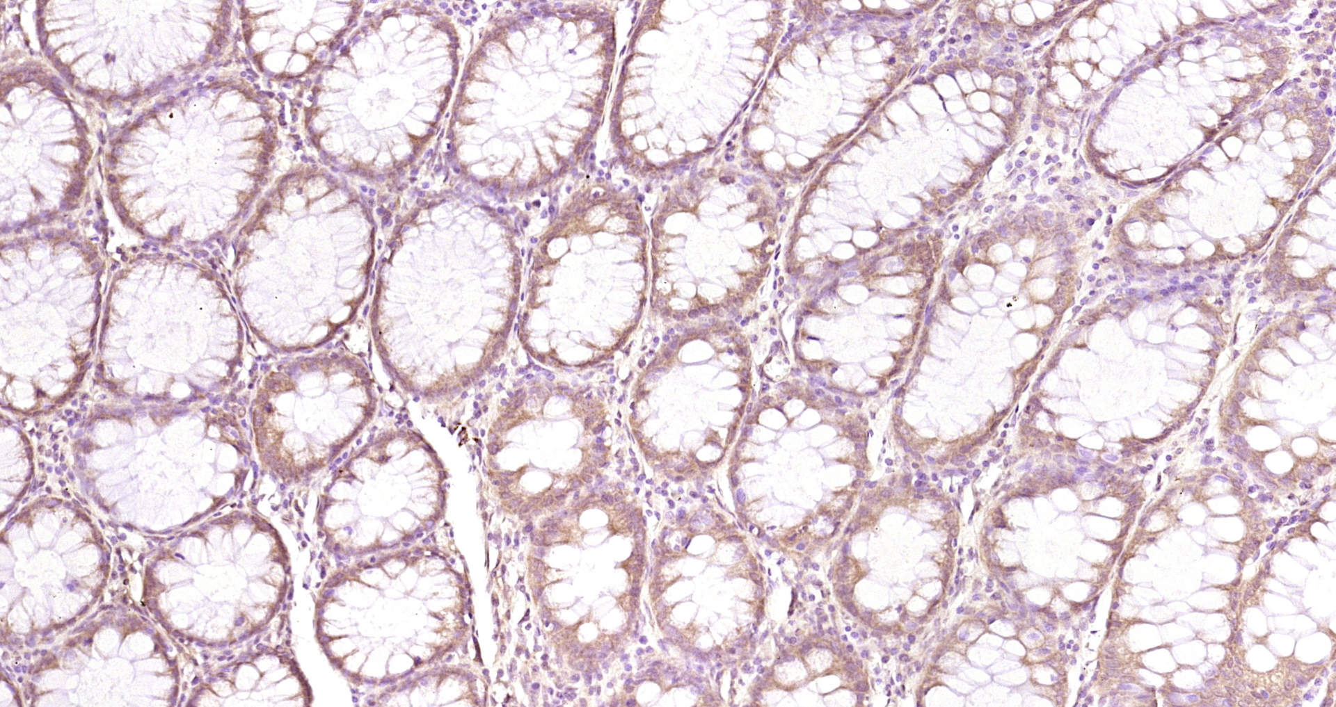 Paraformaldehyde-fixed, paraffin embedded Human colon cancer; Antigen retrieval by boiling in sodium citrate buffer (pH6.0) for 15min; Block endogenous peroxidase by 3% hydrogen peroxide for 20 minutes; Blocking buffer (normal goat serum) at 37°C for 30min; Antibody incubation with SPARC Polyclonal Antibody, Unconjugated (bs-1133R) at 1:200 overnight at 4°C, DAB staining.