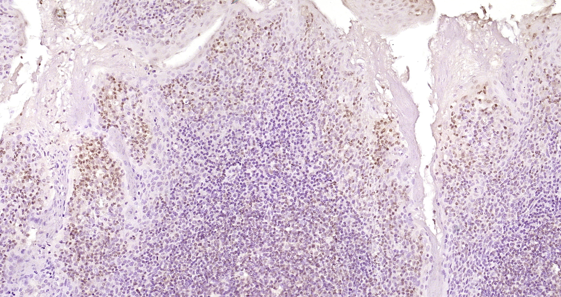 Paraformaldehyde-fixed, paraffin embedded Human tonsil; Antigen retrieval by boiling in sodium citrate buffer (pH6.0) for 15min; Block endogenous peroxidase by 3% hydrogen peroxide for 20 minutes; Blocking buffer (normal goat serum) at 37°C for 30min; Antibody incubation with OGG1 Polyclonal Antibody, Unconjugated (bs-3687R) at 1:200 overnight at 4°C, DAB staining.
