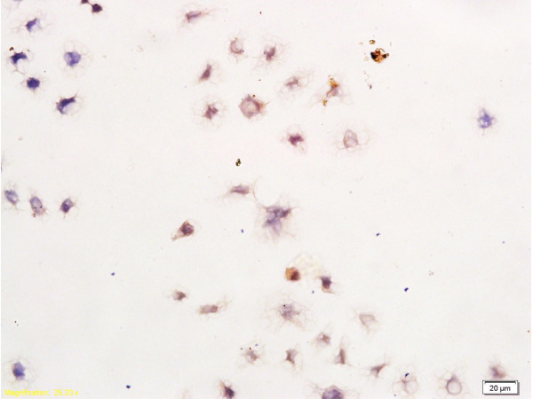 Human Gastric Cancer Cells labeled with Anti-Survivin Polyclonal Antibody, Unconjugated (bs-0615R) at 1:300, followed by conjugation to the secondary antibody and DAB staining
