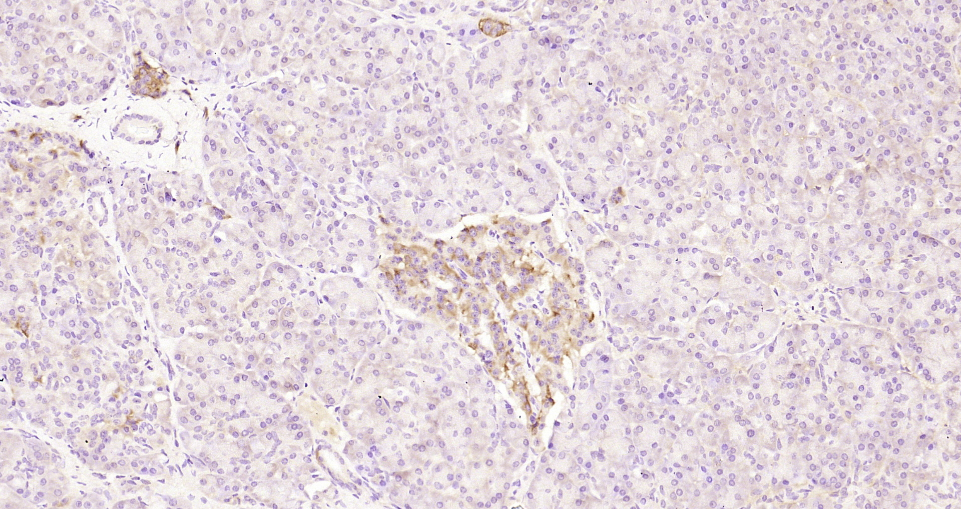 Paraformaldehyde-fixed, paraffin embedded Human pancreatic cancer; Antigen retrieval by boiling in sodium citrate buffer (pH6.0) for 15min; Block endogenous peroxidase by 3% hydrogen peroxide for 20 minutes; Blocking buffer (normal goat serum) at 37°C for 30min; Antibody incubation with MEK5(Ser129) Polyclonal Antibody, Unconjugated (bs-5431R) at 1:200 overnight at 4°C, DAB staining.