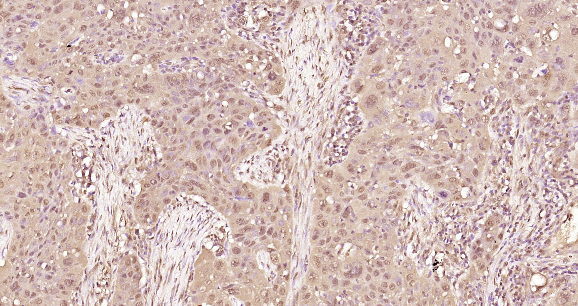 Paraformaldehyde-fixed, paraffin embedded Human laryngeal cancer; Antigen retrieval by boiling in sodium citrate buffer (pH6.0) for 15min; Block endogenous peroxidase by 3% hydrogen peroxide for 20 minutes; Blocking buffer (normal goat serum) at 37°C for 30min; Antibody incubation with RAD51(Thr309) Polyclonal Antibody, Unconjugated (bs-5677R) at 1:200 overnight at 4°C, DAB staining.