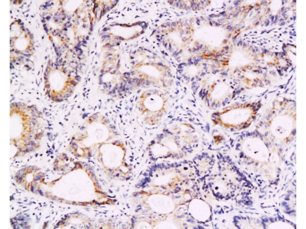 Formalin-fixed and paraffin embedded human colon carcinoma labeled with Anti-Survivin Polyclonal Antibody, Unconjugated (bs-0615R) at 1:200, followed by conjugation to the secondary antibody and DAB staining