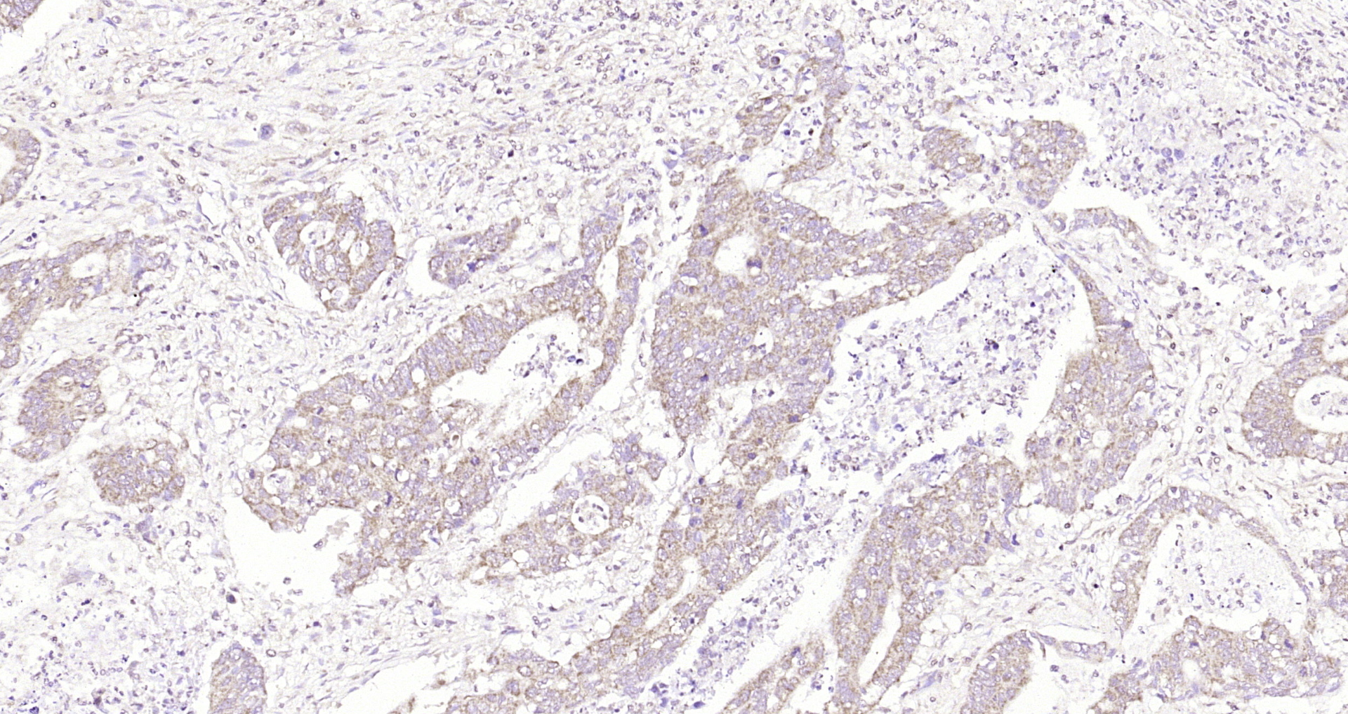 Paraformaldehyde-fixed, paraffin embedded Human colon cancer; Antigen retrieval by boiling in sodium citrate buffer (pH6.0) for 15min; Block endogenous peroxidase by 3% hydrogen peroxide for 20 minutes; Blocking buffer (normal goat serum) at 37°C for 30min; Antibody incubation with GRAP2 Polyclonal Antibody, Unconjugated (bs-6164R) at 1:200 overnight at 4°C, DAB staining.