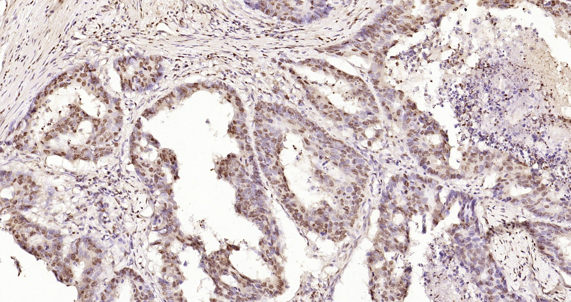 Paraformaldehyde-fixed, paraffin embedded Human colon cancer; Antigen retrieval by boiling in sodium citrate buffer (pH6.0) for 15min; Block endogenous peroxidase by 3% hydrogen peroxide for 20 minutes; Blocking buffer (normal goat serum) at 37°C for 30min; Antibody incubation with CIDEC Polyclonal Antibody, Unconjugated (bs-6796R) at 1:200 overnight at 4°C, DAB staining.