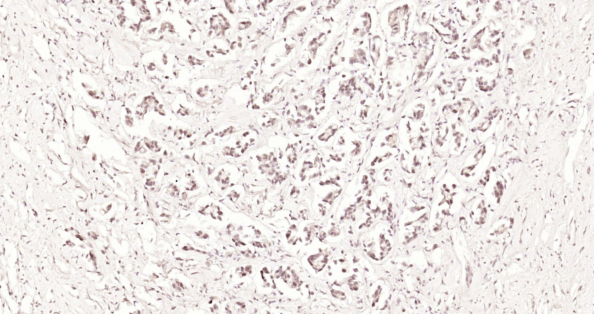 Paraformaldehyde-fixed, paraffin embedded Human stomach cancer; Antigen retrieval by boiling in sodium citrate buffer (pH6.0) for 15min; Block endogenous peroxidase by 3% hydrogen peroxide for 20 minutes; Blocking buffer (normal goat serum) at 37°C for 30min; Antibody incubation with RERE Polyclonal Antibody, Unconjugated (bs-7077R) at 1:200 overnight at 4°C, DAB staining.