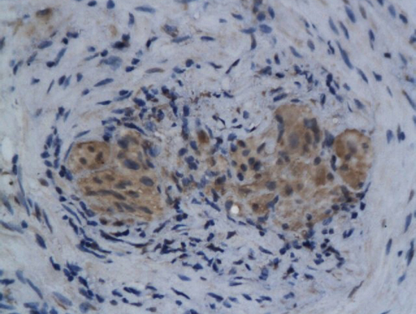 Formalin-fixed and paraffin embedded human colorectal cancer labeled with Anti-Anei-ATX/Autotaxin Polyclonal Antibody, Unconjugated (bs-2437R) followed by conjugation to the secondary antibody Formalin-fixed and paraffin embedded human colorectal cancer labeled with Anti-Anei-ATX/Autotaxin Polyclonal Antibody, Unconjugated (bs-2437R) followed by conjugation to the secondary antibody