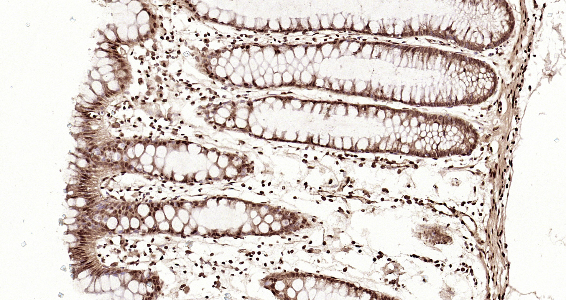 Paraformaldehyde-fixed, paraffin embedded Human colon cancer; Antigen retrieval by boiling in sodium citrate buffer (pH6.0) for 15min; Block endogenous peroxidase by 3% hydrogen peroxide for 20 minutes; Blocking buffer (normal goat serum) at 37°C for 30min; Antibody incubation with IGF2BP1 Polyclonal Antibody, Unconjugated (bs-8683R) at 1:200 overnight at 4°C, DAB staining.